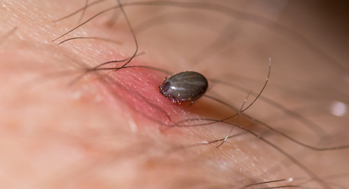 A tick attached to the skin of someone’s arm - the area is red and swollen