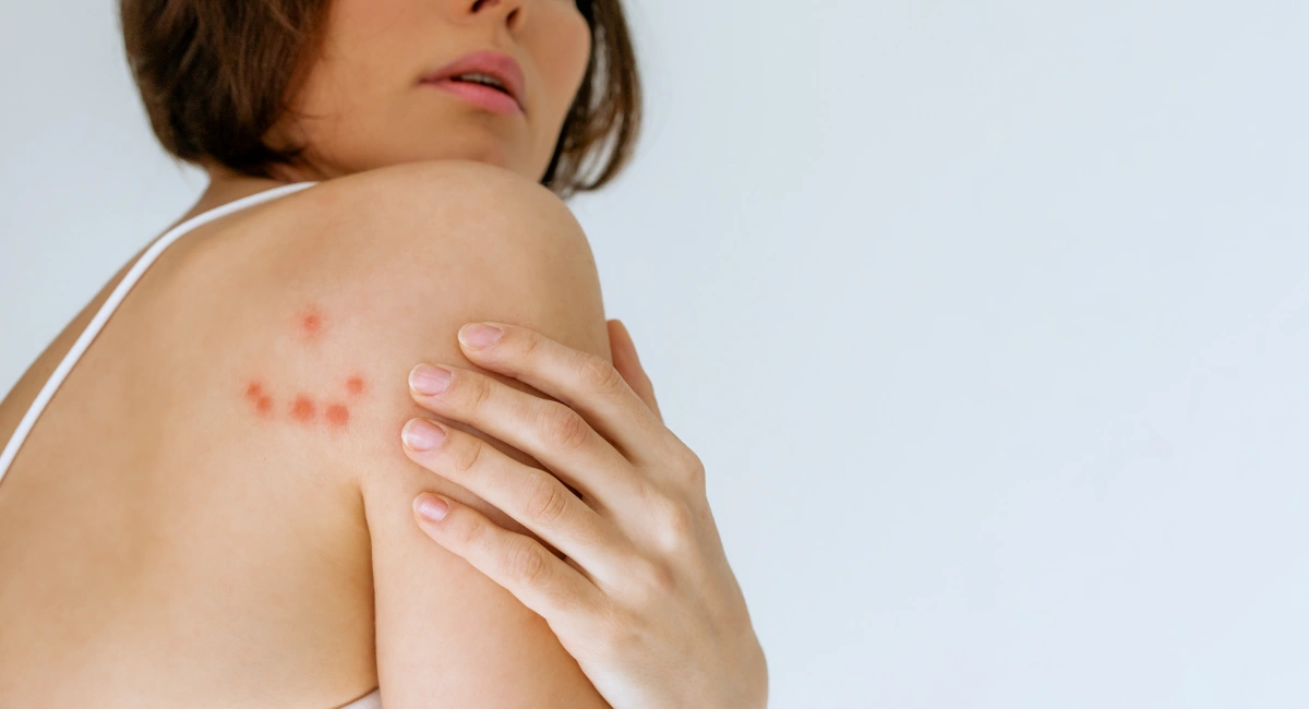 Bites are red, itchy and inflamed