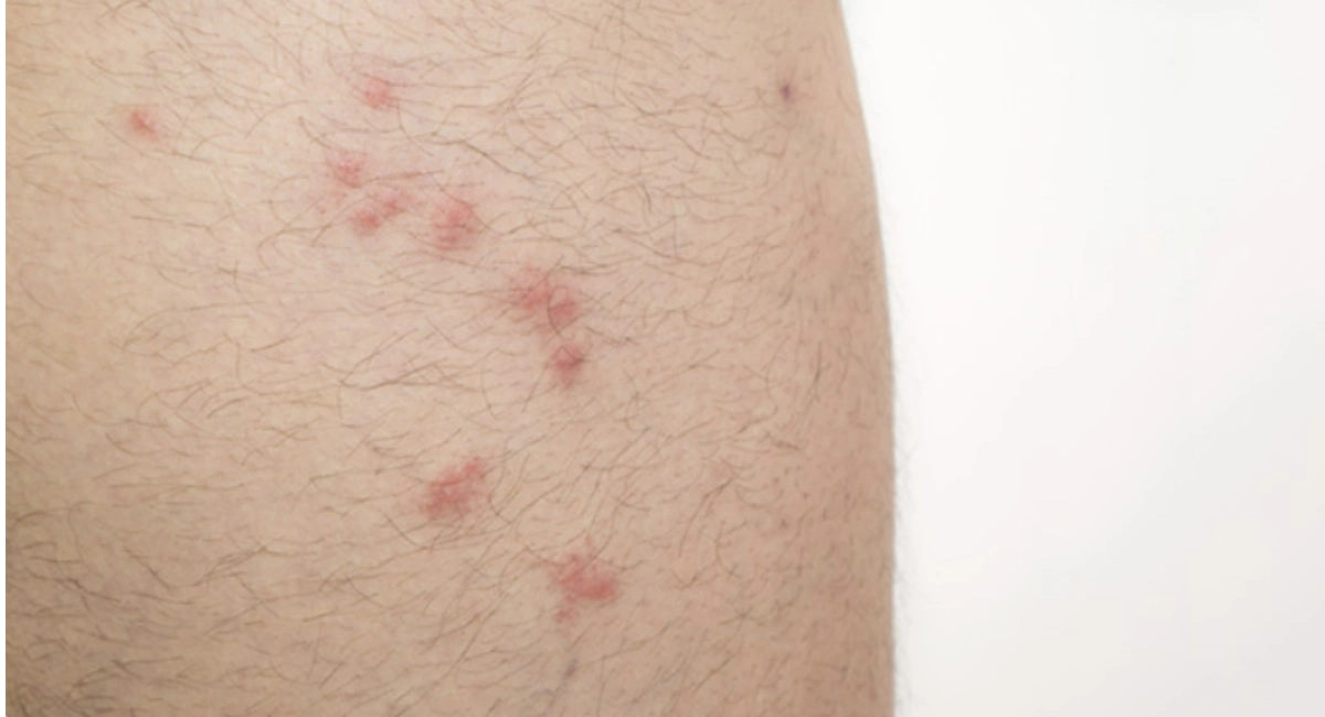 flea bites on leg