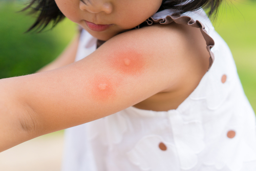 A young girl with large swollen mosquito bites on her arm.